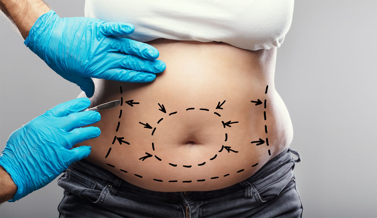 liposuction in turkey