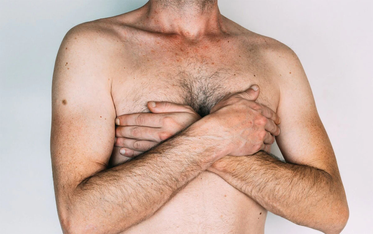 What is Gynecomastia