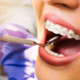 dental coating material