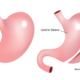Was sind die Vorteile der Magenverkleinerungs Operation (Sleeve Gastrektomie)?
