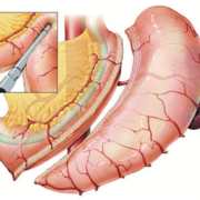 Schlauchmagenoperation-Sleeve Gastrektomie
