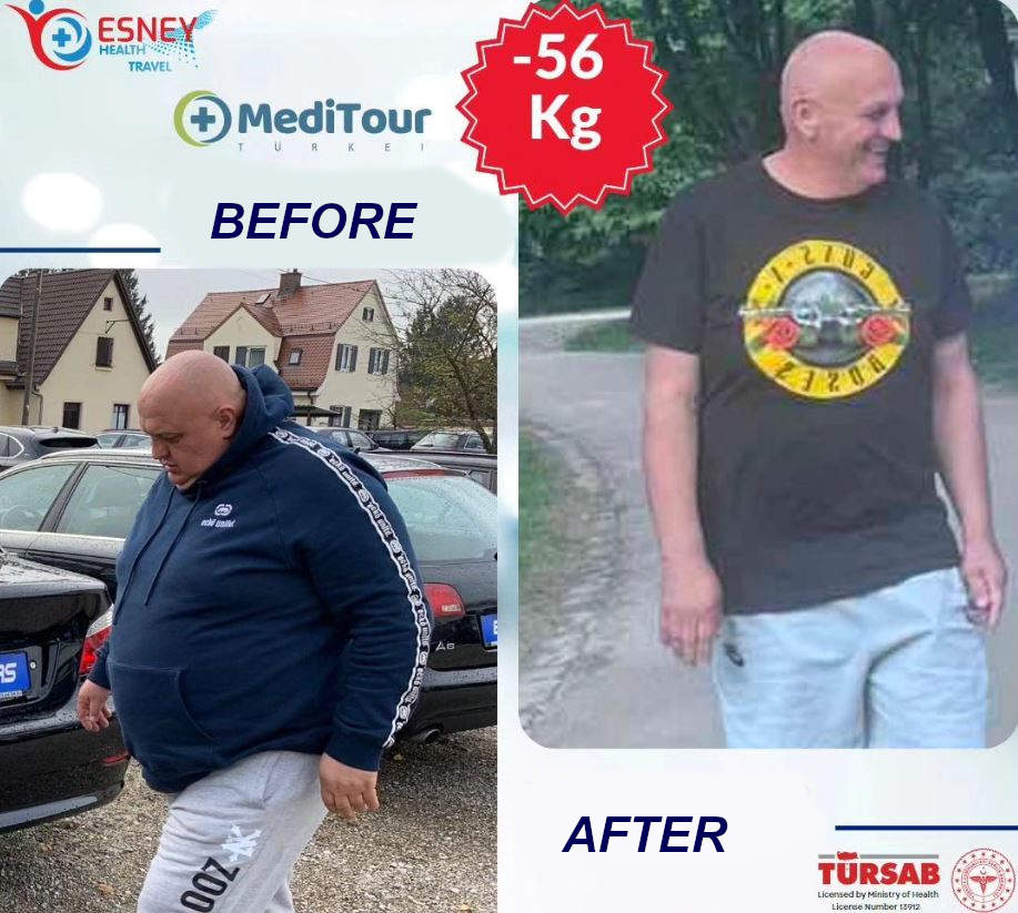 gastric sleeve turkey 1