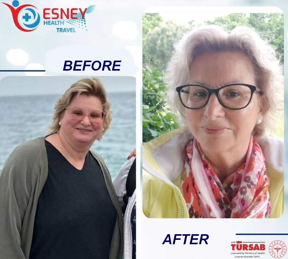 gastric sleeve turkey 5