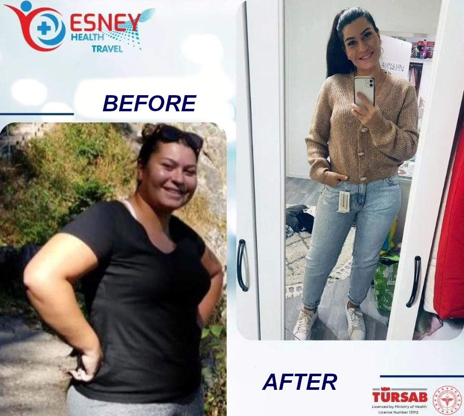 gastric sleeve turkey 8